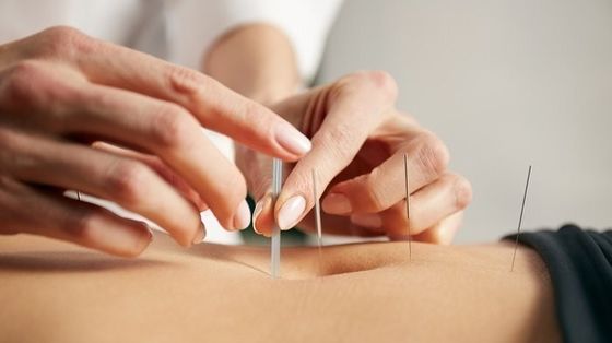 مسامير الوخز بالإبر داخل الجلد التجميلية والطبية هيكل مستقيم يضمن السلامة والفعالية في الوخز بالإبر